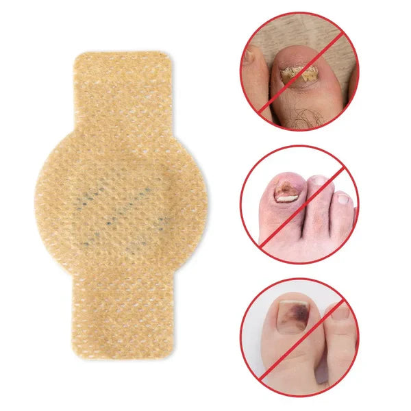 Plasturi medicinali pentru tratamentul unghiilor